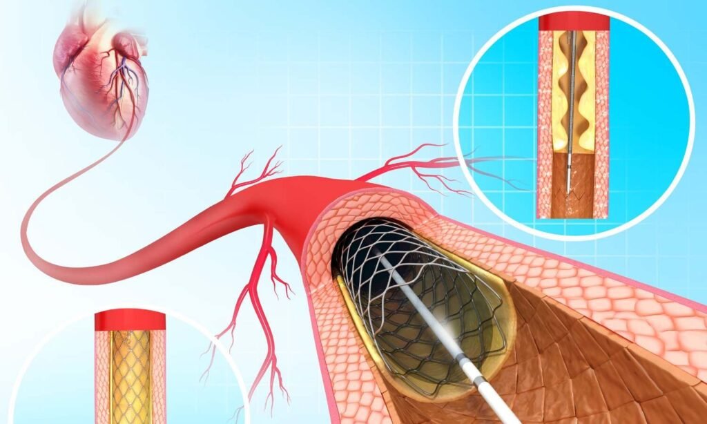 Focal Coronary Disease Predicts Greater Benefit from PCI in Stable Angina: ORBITA-2 trial Analysis