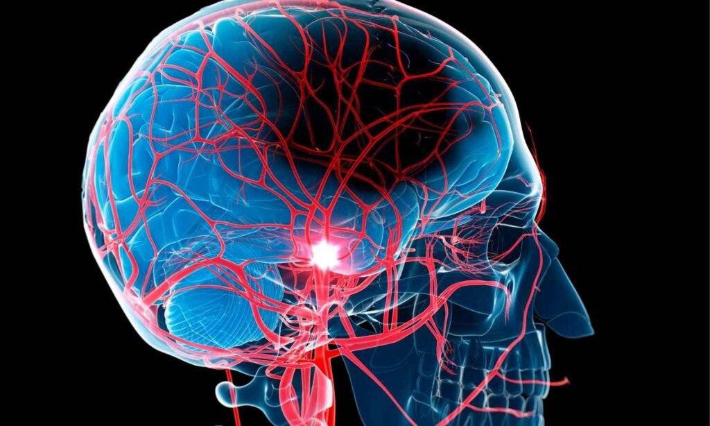 Intra-Arterial Alteplase After Thrombectomy May Improve large vessel Stroke Recovery: JAMA