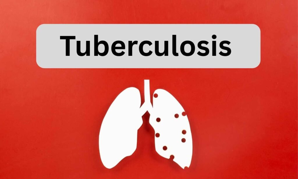 An Ultrasensitive molecular Test may Reveal Hidden Tuberculosis Burden, suggests research