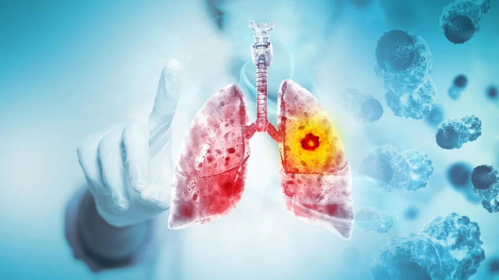 Major review finds vaping likely causes lung and oral cancer