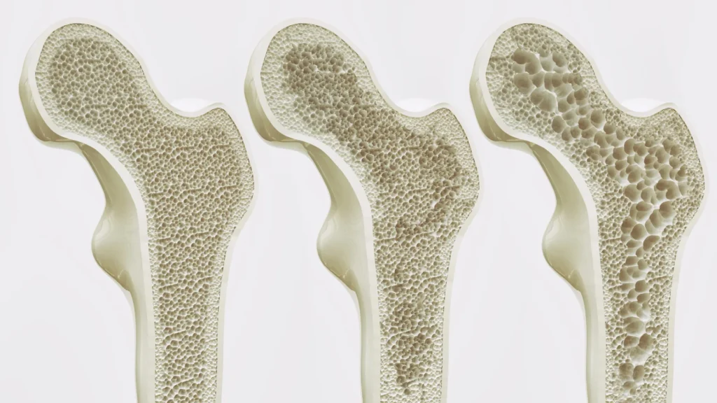 Semaglutide (Ozempic) linked to fewer bone fractures despite greater weight loss