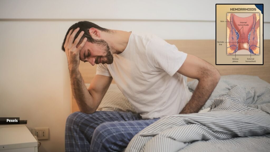 ‘Can piles go away on their own?’ | Health News