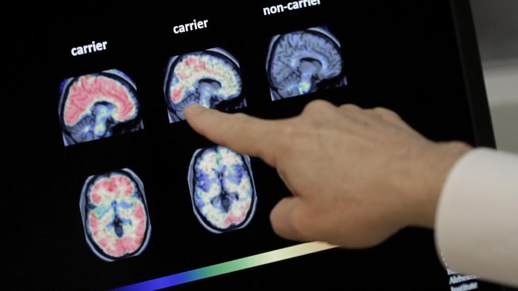Study: Diabetes, hearing loss among key factors for dementia in India; women more prone