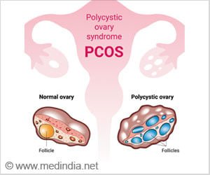 PMOS Linked to 4-Fold Increase in Heart Disease Risk