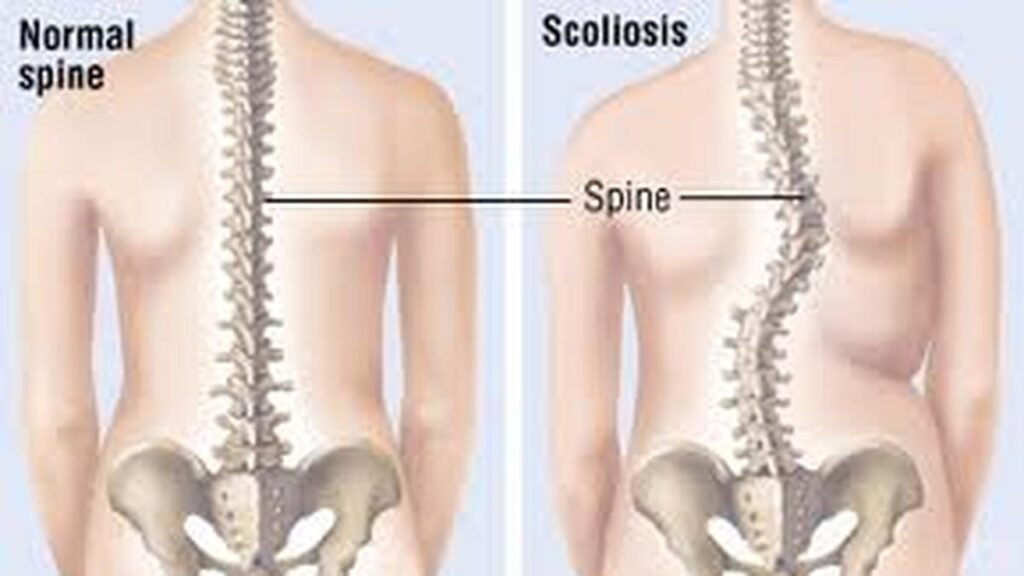 All you need to know about: scoliosis