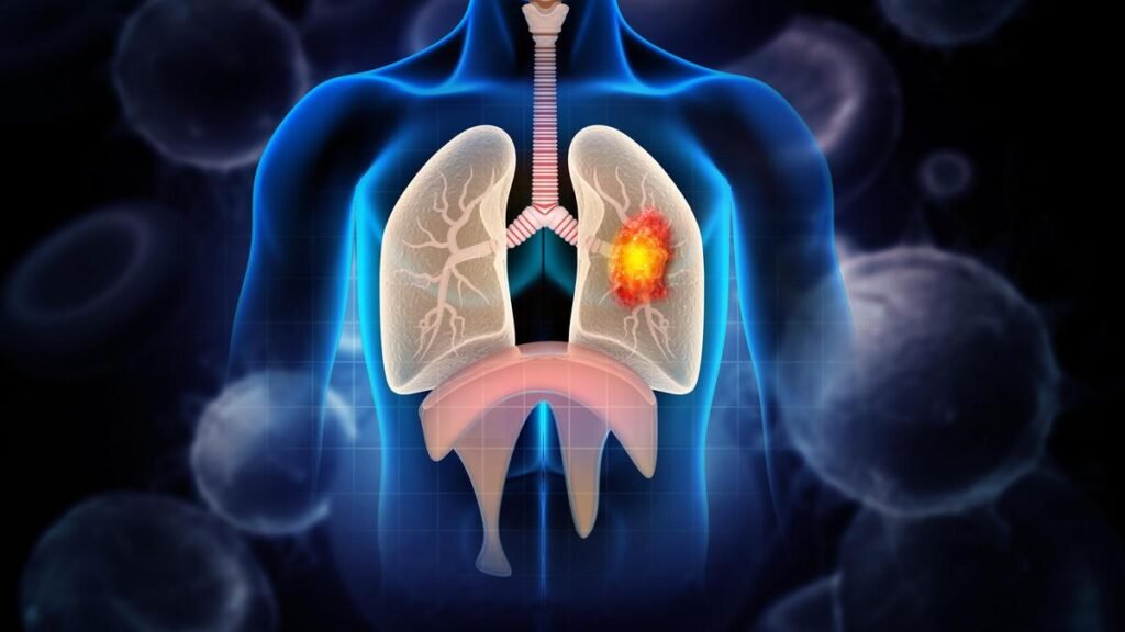 Lung cancer accounts for 6% of cancer cases in Karnataka; tobacco remains biggest risk factor