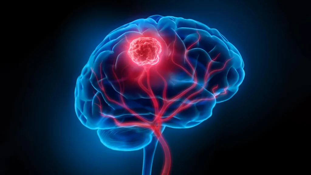 Smart nanoparticles light up brain cancer and destroy what surgery misses