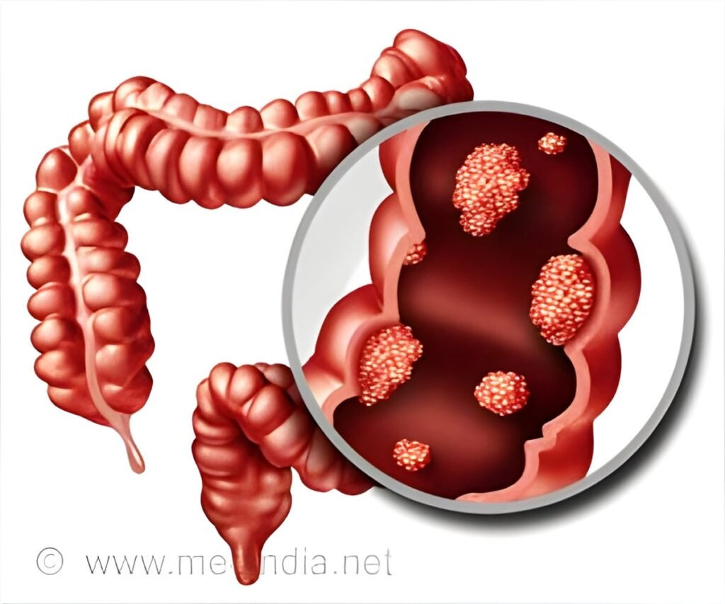Rectal Cancer Trial Finds Longer Chemoradiotherapy May Reduce Need for Surgery