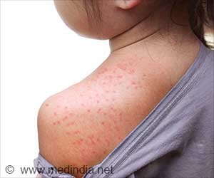 Measles Exposure Warning Issued for Universal Studios Hollywood
