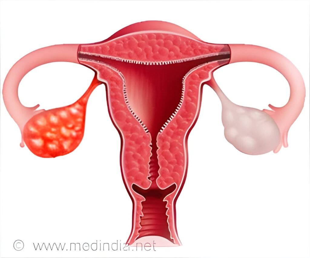 Woman With Ovarian Cancer First to Receive New Cell Therapy