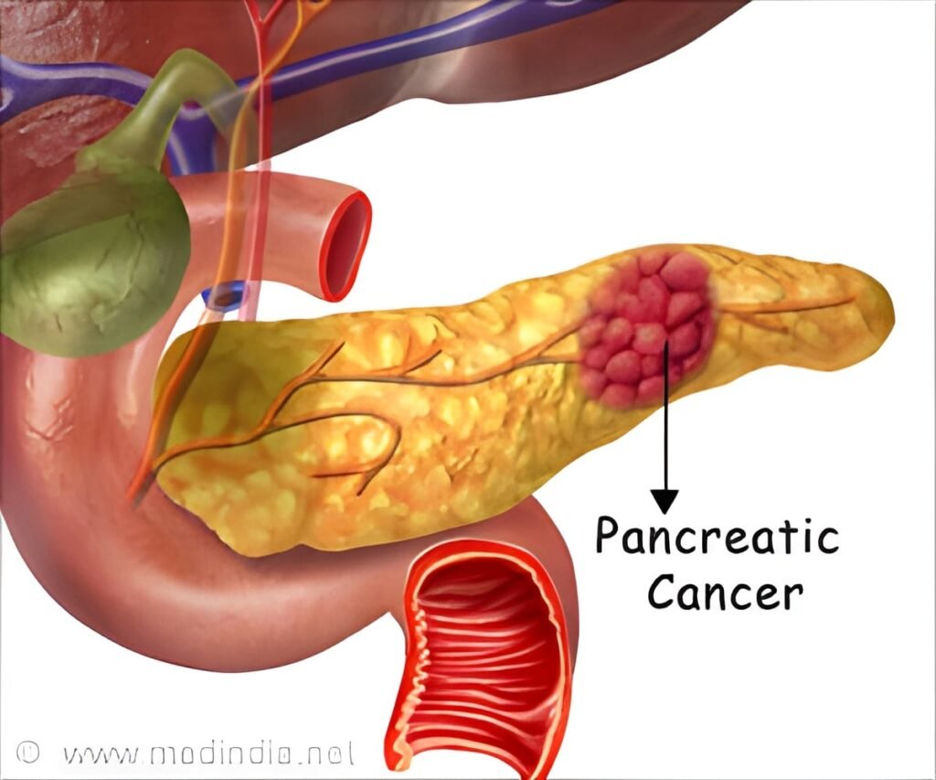 Experimental KRAS Vaccine Could Prevent Pancreatic Cancer