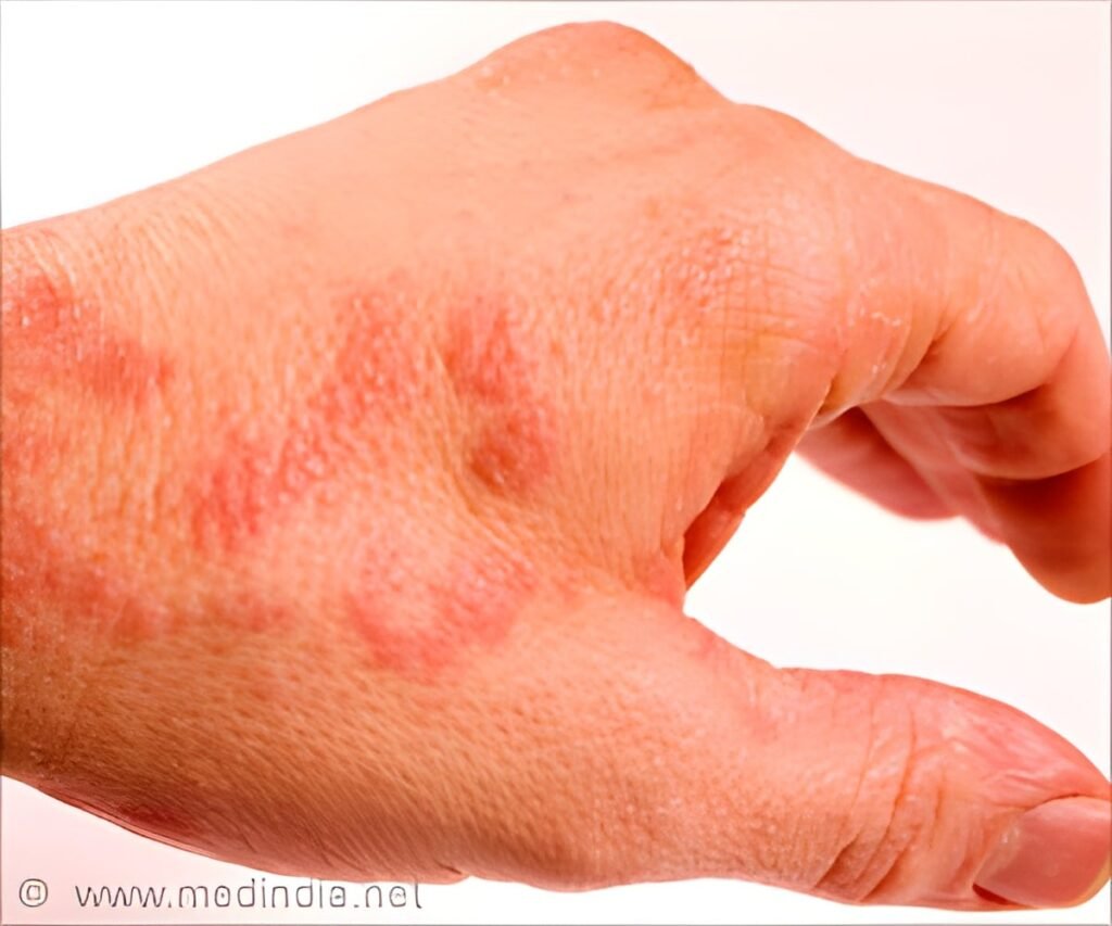 Eczema Linked to Higher Shingles Risk
