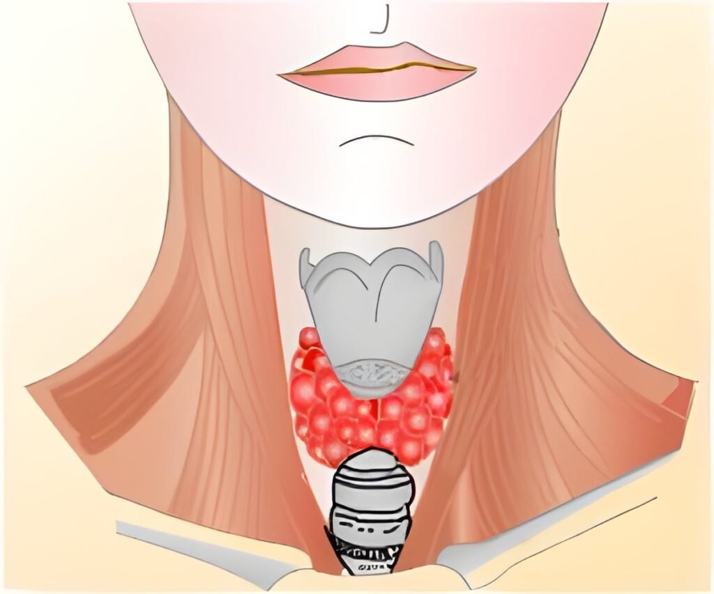 One in Five Women With Infertility Have Thyroid Antibodies